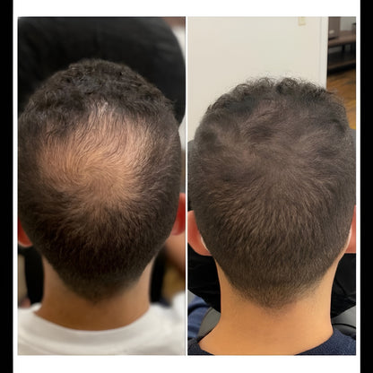 Advanced 0.5mm Derma Roller | Acne Scars, Hair Regrowth & Glowing Skin