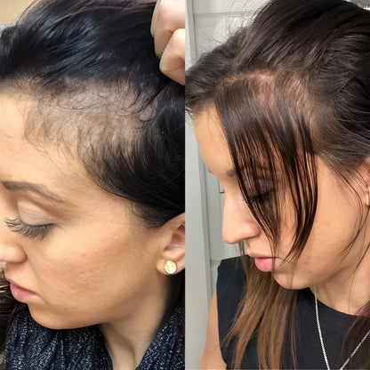 Advanced 0.5mm Derma Roller | Acne Scars, Hair Regrowth & Glowing Skin